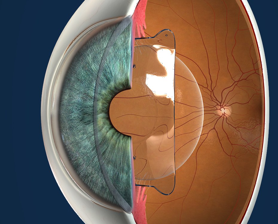 3D-Illustration: ICL-Kunstlinse sitzt hinter der Iris im Auge