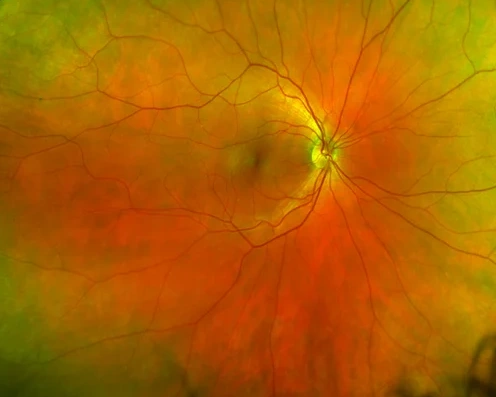 Netzhautaufnahme (Retinal Mapping): Augenhintergrund mit Sehnerv, Makula und Blutgefässen